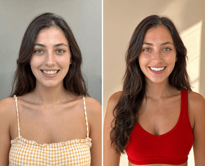 Smile Clarity patient result 5